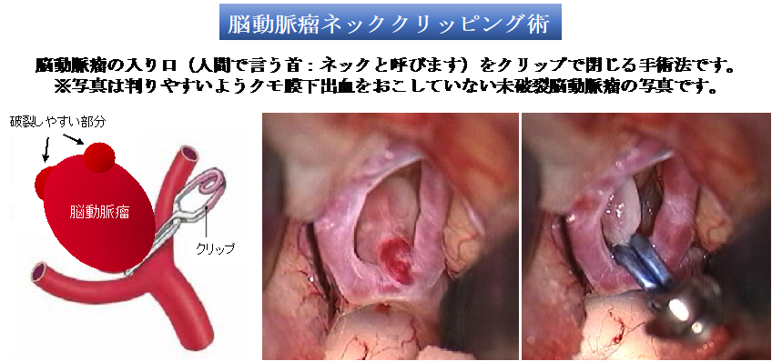 脳動脈瘤ネッククリッピング術