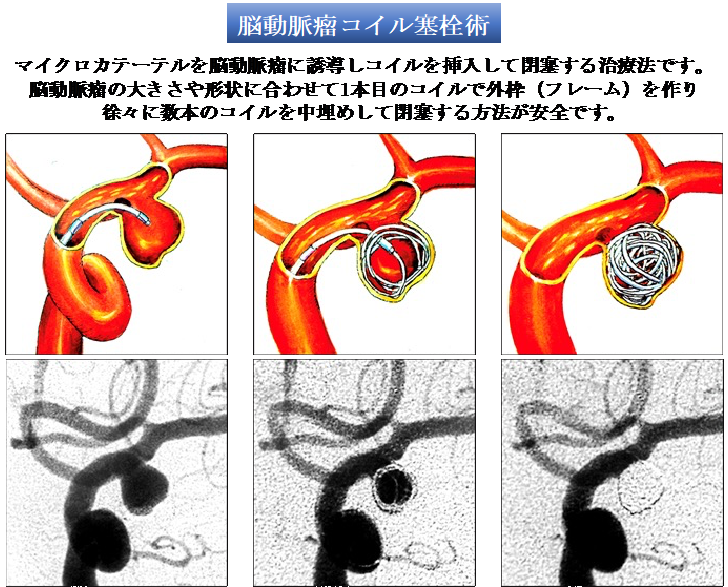 脳動脈瘤コイル塞栓術